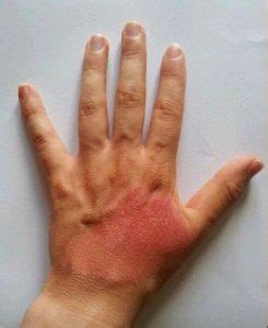 what to do if you touch battery acid|Battery Acid on Skin: Symptoms,。